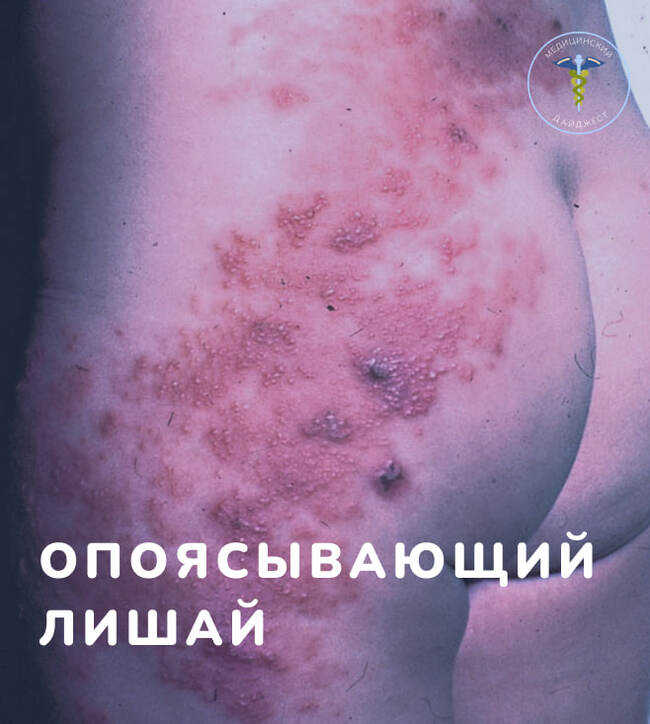 Shingles - Treatment, The medicine, Health, Disease, Herpes