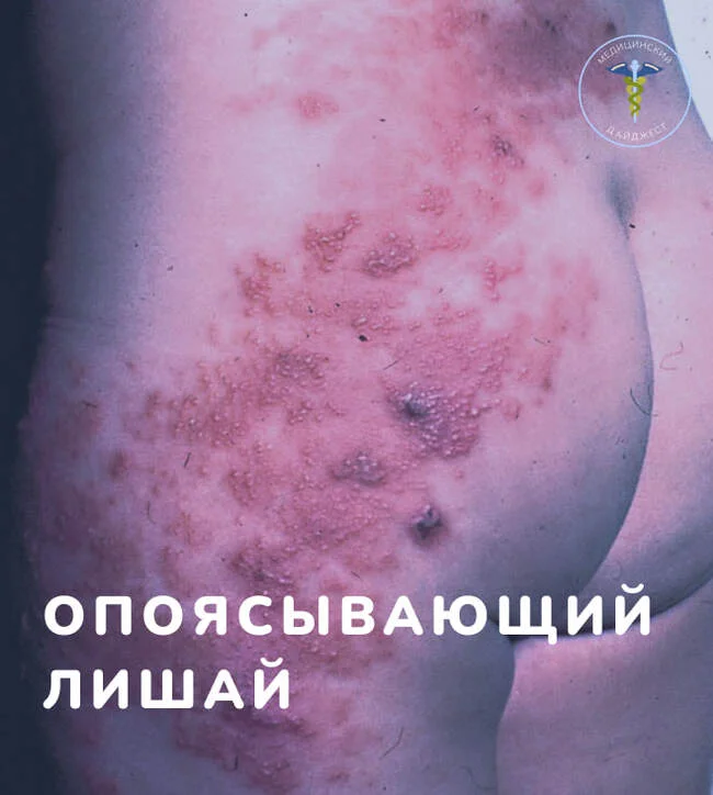 Shingles - Treatment, The medicine, Health, Disease, Herpes