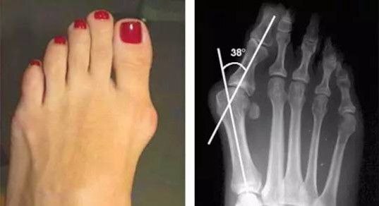 HALLUX VALGUS , , , 