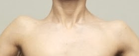 Trapezius muscle - My, The medicine, Question, Ask Peekaboo, Scoliosis, Muscle, Problem, Need advice, Consultation, Training apparatus, PHYSICAL THERAPY