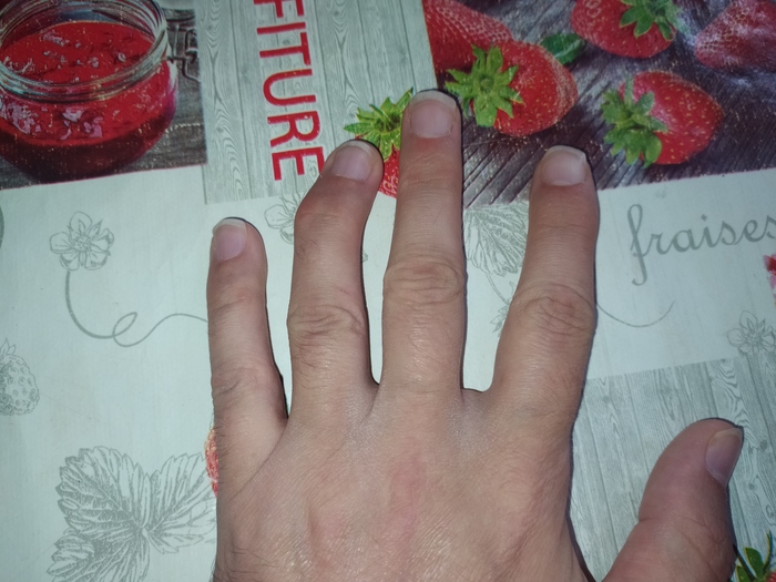 Перелом сустава