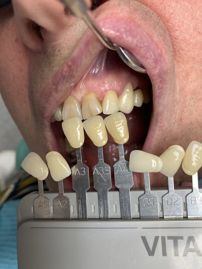 Примерка конструкций и дополнительное фото для более точного понимания необходимой индивидуализации.