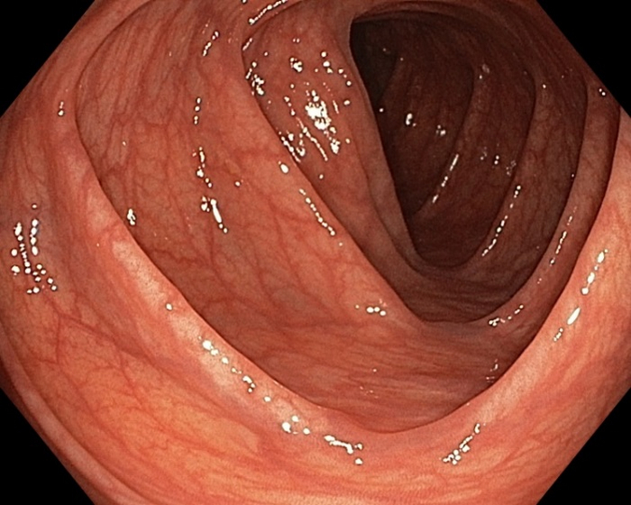 Вот так выглядела моя кишка