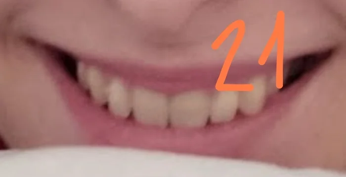 Question for orthodontists: teeth have moved apart despite having a retainer - My, Dentistry, Orthodontics, Question, Braces, Ask Peekaboo