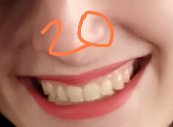 Question for orthodontists: teeth have moved apart despite having a retainer - My, Dentistry, Orthodontics, Question, Braces, Ask Peekaboo