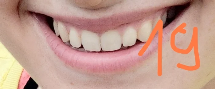 Question for orthodontists: teeth have moved apart despite having a retainer - My, Dentistry, Orthodontics, Question, Braces, Ask Peekaboo