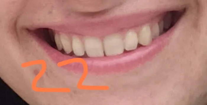 Question for orthodontists: teeth have moved apart despite having a retainer - My, Dentistry, Orthodontics, Question, Braces, Ask Peekaboo