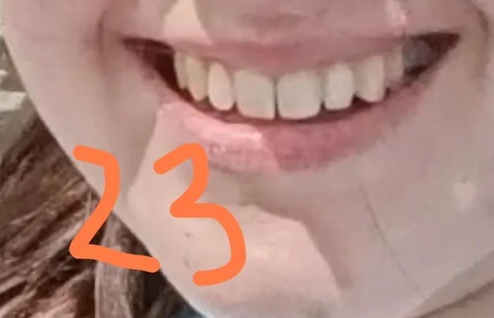Question for orthodontists: teeth have moved apart despite having a retainer - My, Dentistry, Orthodontics, Question, Braces, Ask Peekaboo