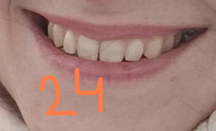 Question for orthodontists: teeth have moved apart despite having a retainer - My, Dentistry, Orthodontics, Question, Braces, Ask Peekaboo