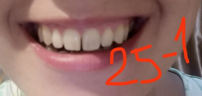 Question for orthodontists: teeth have moved apart despite having a retainer - My, Dentistry, Orthodontics, Question, Braces, Ask Peekaboo