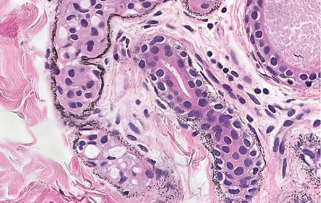 Скопление серебряных гранул в базальной мембране потовых желез