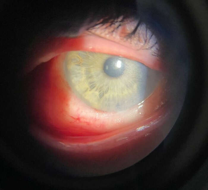 Повторил тренд из Тикток - чуть не остался без глаз