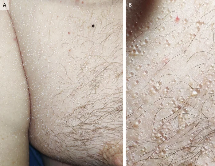 Poplar fluff, heat, prickly heat - Series Diseases of the skin appendages, My, The medicine, Leather, Health, Sweat, Dermatology, Dermatitis, Hyperhidrosis, sweating, Longpost