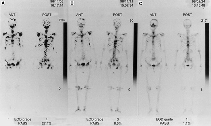 Серийное сканирование костей у пациента, у которого наблюдалось улучшение метастазов в костях после радионуклидной терапии: (A) до лечения; (B) через 12 месяцев после лечения; (C) через 27 месяцев после лечения.