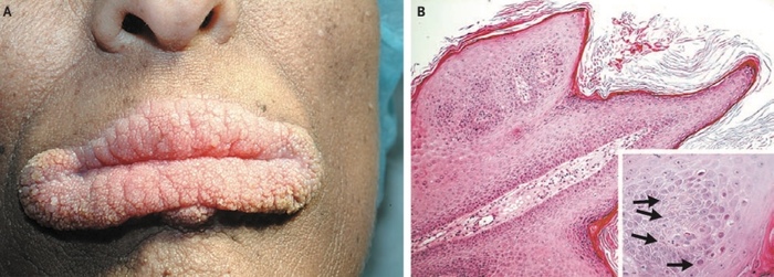 Злокачественный черный акантоз