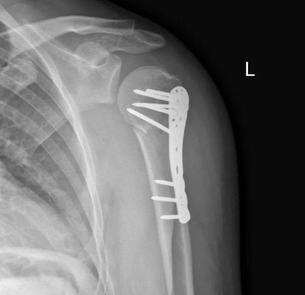Humerus fracture and osteosynthesis - Hospital, Disease history, Osteosynthesis, Broken arm, Longpost