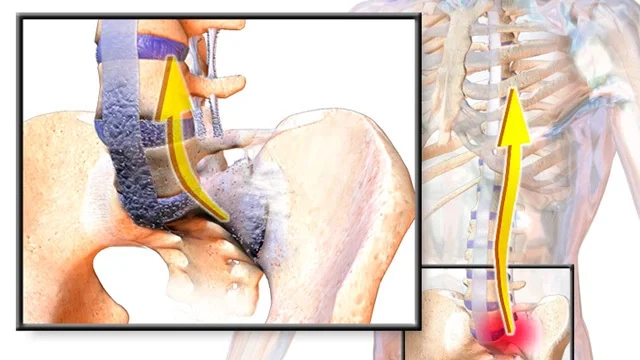 Fedor and back pain - My, The medicine, Rheumatology, Rheumatologist, Ankylosing spondylitis, Bechterew's disease, Diagnostics