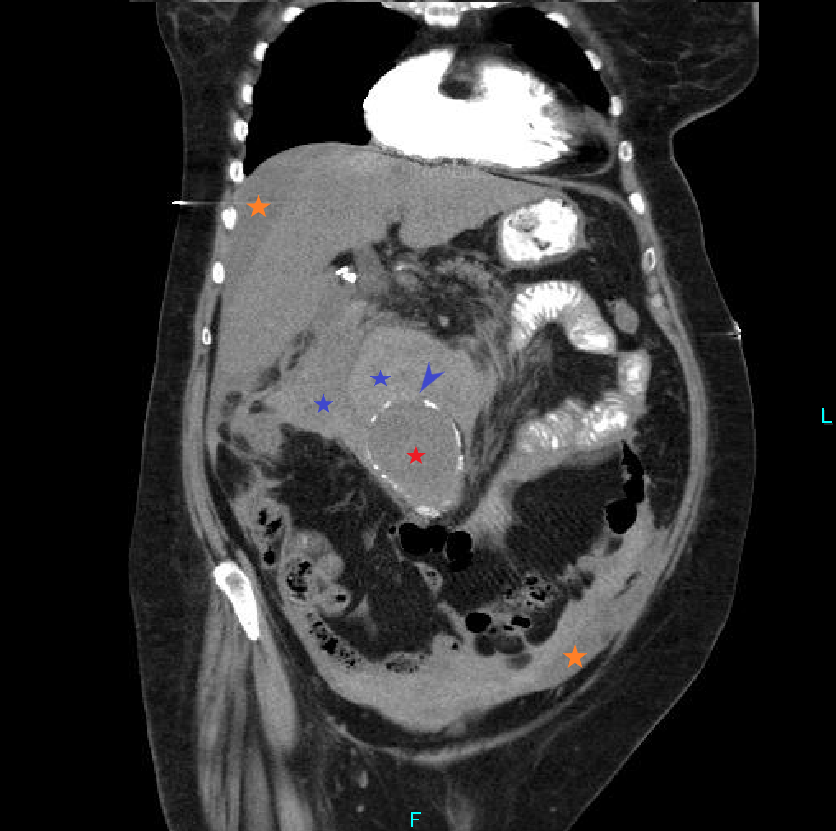 Case reports: ruptured aortic aneurysm - My, The medicine, Disease history, Observation, Disease, Aneurysm, CT, Radiology, Longpost