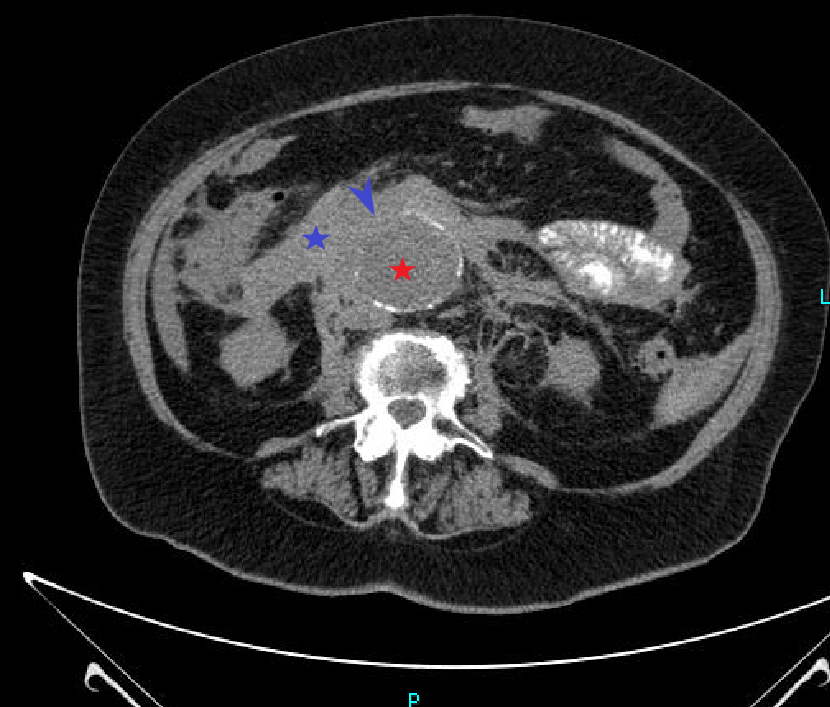 Case reports: ruptured aortic aneurysm - My, The medicine, Disease history, Observation, Disease, Aneurysm, CT, Radiology, Longpost