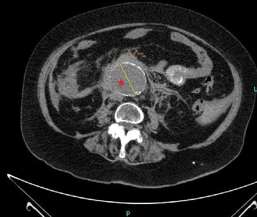 Case reports: ruptured aortic aneurysm - My, The medicine, Disease history, Observation, Disease, Aneurysm, CT, Radiology, Longpost