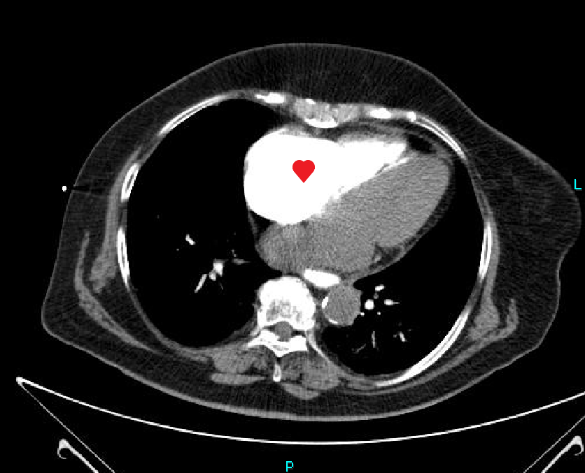 Case reports: ruptured aortic aneurysm - My, The medicine, Disease history, Observation, Disease, Aneurysm, CT, Radiology, Longpost