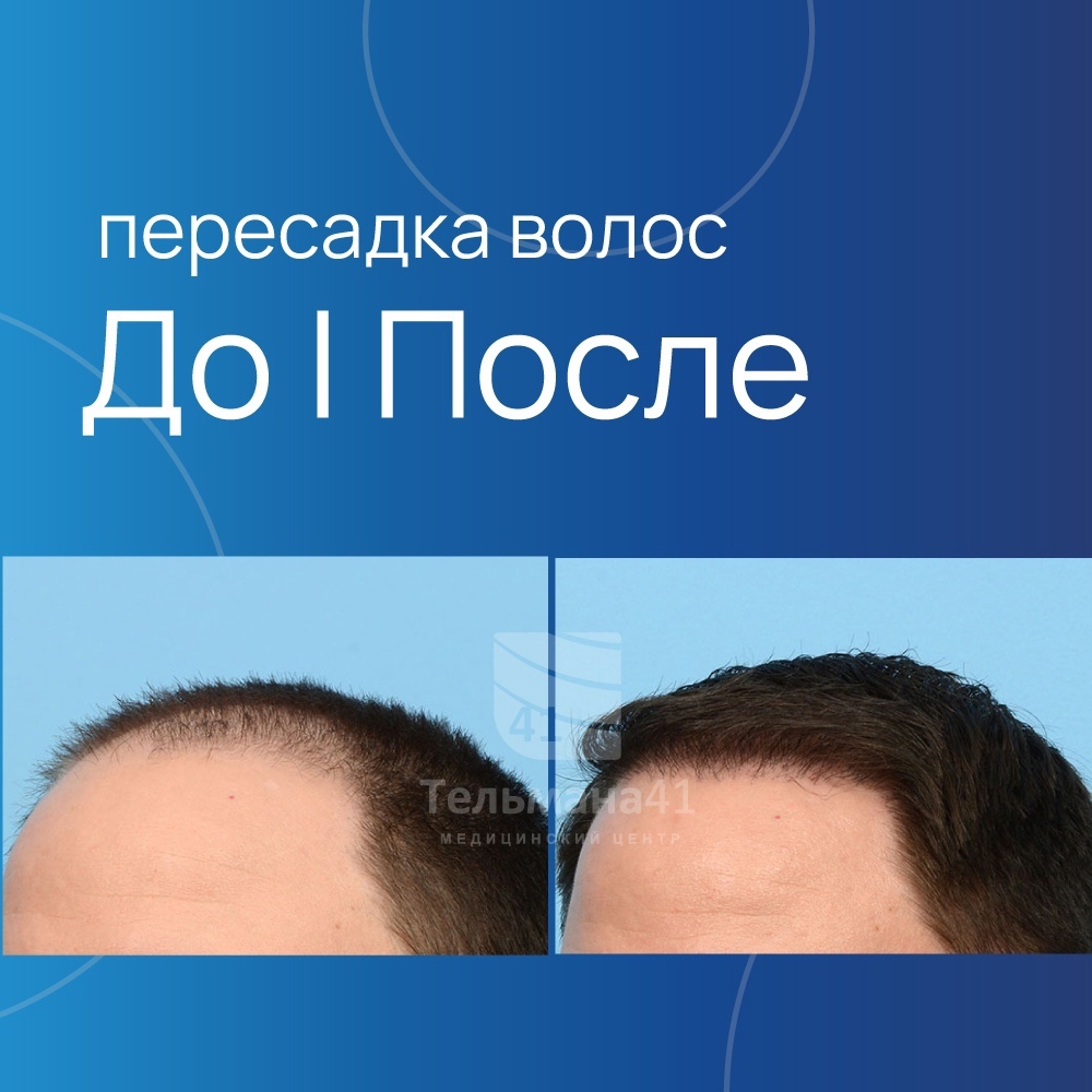 Мы в поисках моделей на трансплантацию волос - Моё, Медицина, Пересадка волос, Алопеция, Очаговая алопеция, Гнездовая алопеция, Трансплантация, Волосы, Лысые, Лысина, Длиннопост