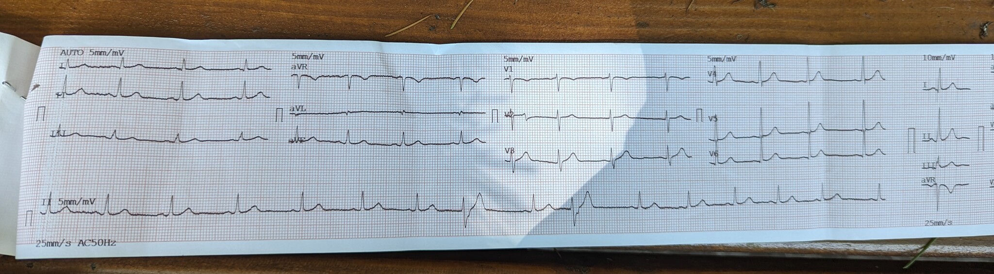 Cardiogram consultation - Question, Ask Peekaboo, Cardiogram, Decryption, Doctors need help