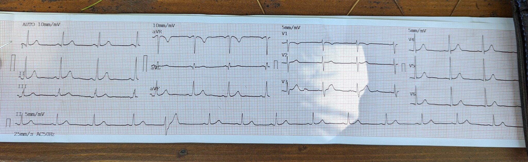 Cardiogram consultation - Question, Ask Peekaboo, Cardiogram, Decryption, Doctors need help