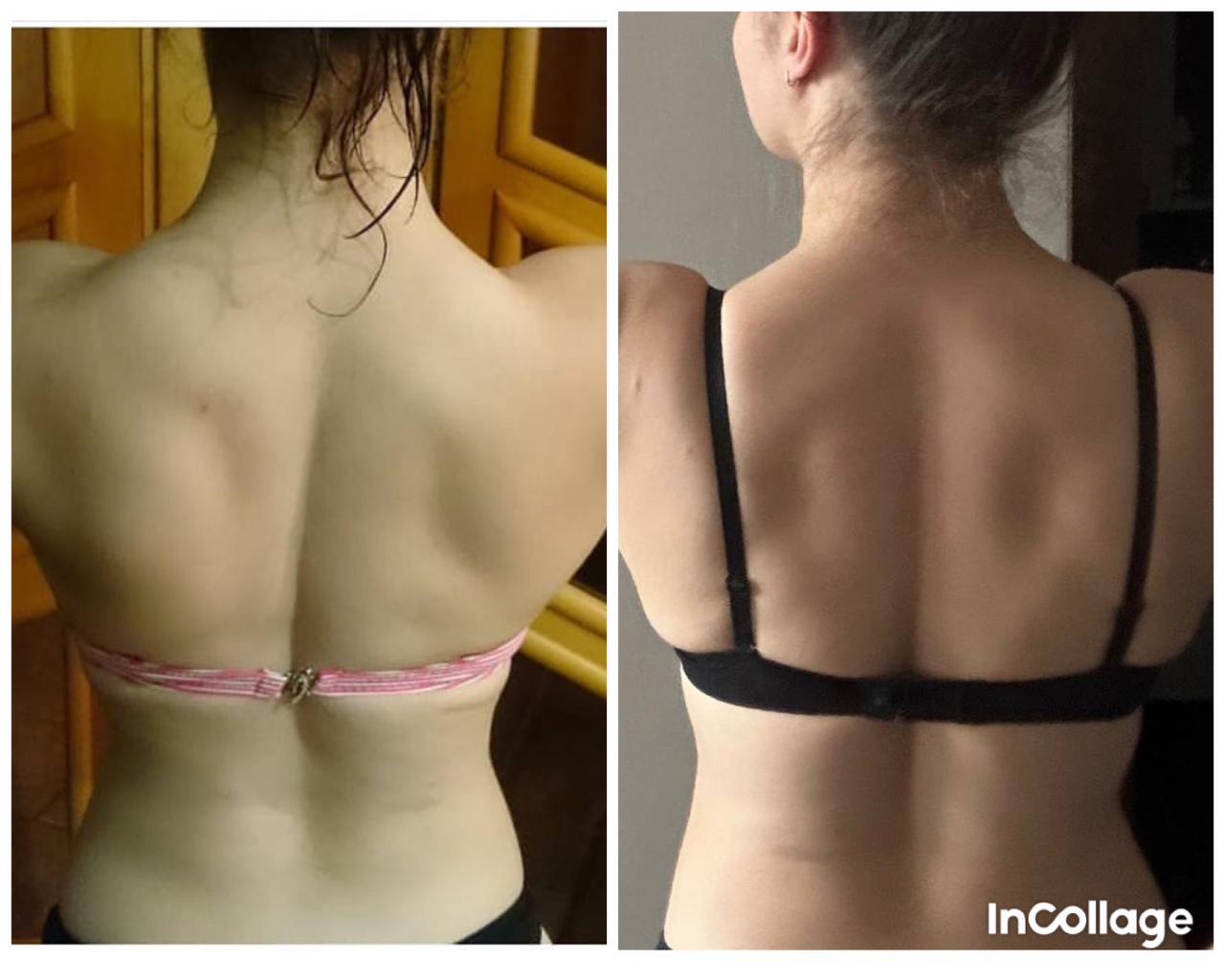 Scoliosis since childhood (long post) - My, Scoliosis, Back, Workout, Powerlifting, Gym, Gym, PHYSICAL THERAPY, Longpost