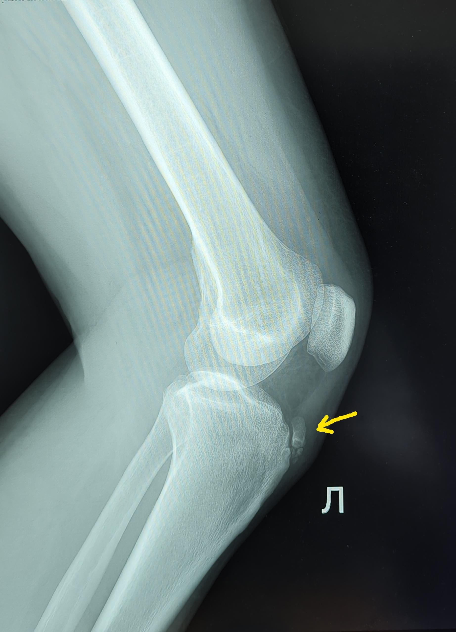 Болезнь Осгуда-Шляттера - Моё, Медицина, Военкомат, Армия, Ортопедия, Болезнь, Рентген, Рентгенология, Длиннопост