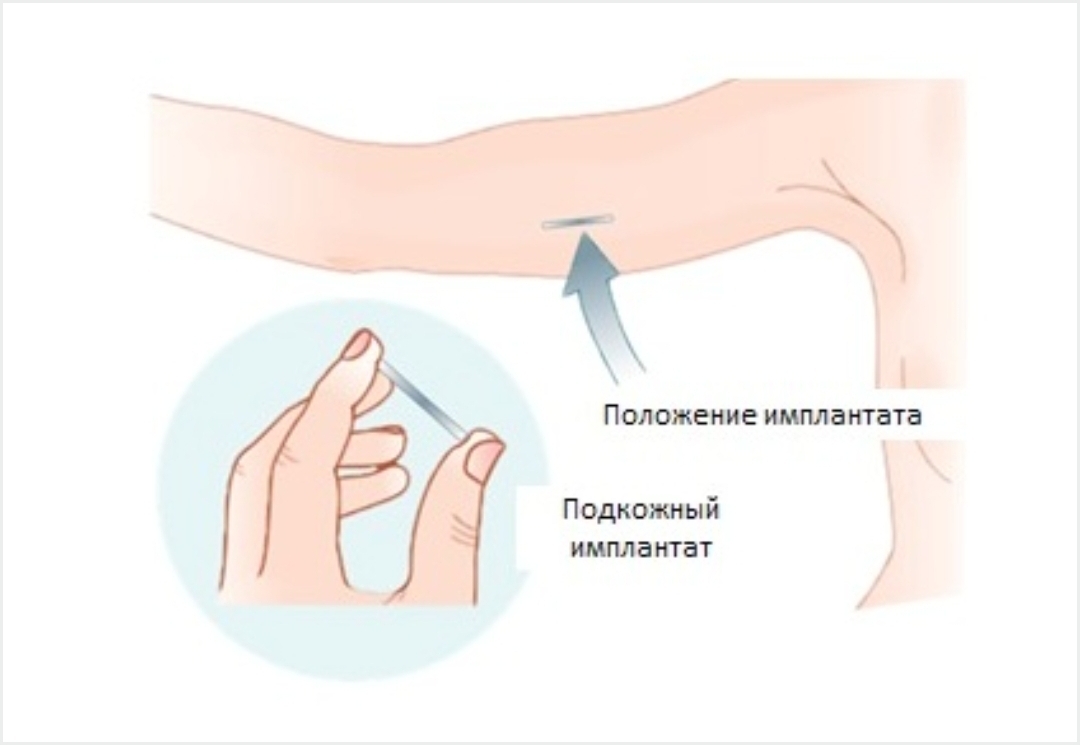 Contraception for women without thrombosis - My, Women, Contraception, Pregnancy, Marriage, Children, Abortion, Health, Clots, Longpost