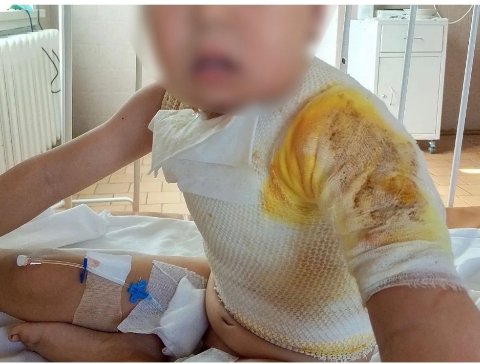 A child was set on fire in Yakutia - Yakutia, Arson, news, Injury, The crime, Mat, Children, Child abuse, Negative, Longpost, Burn