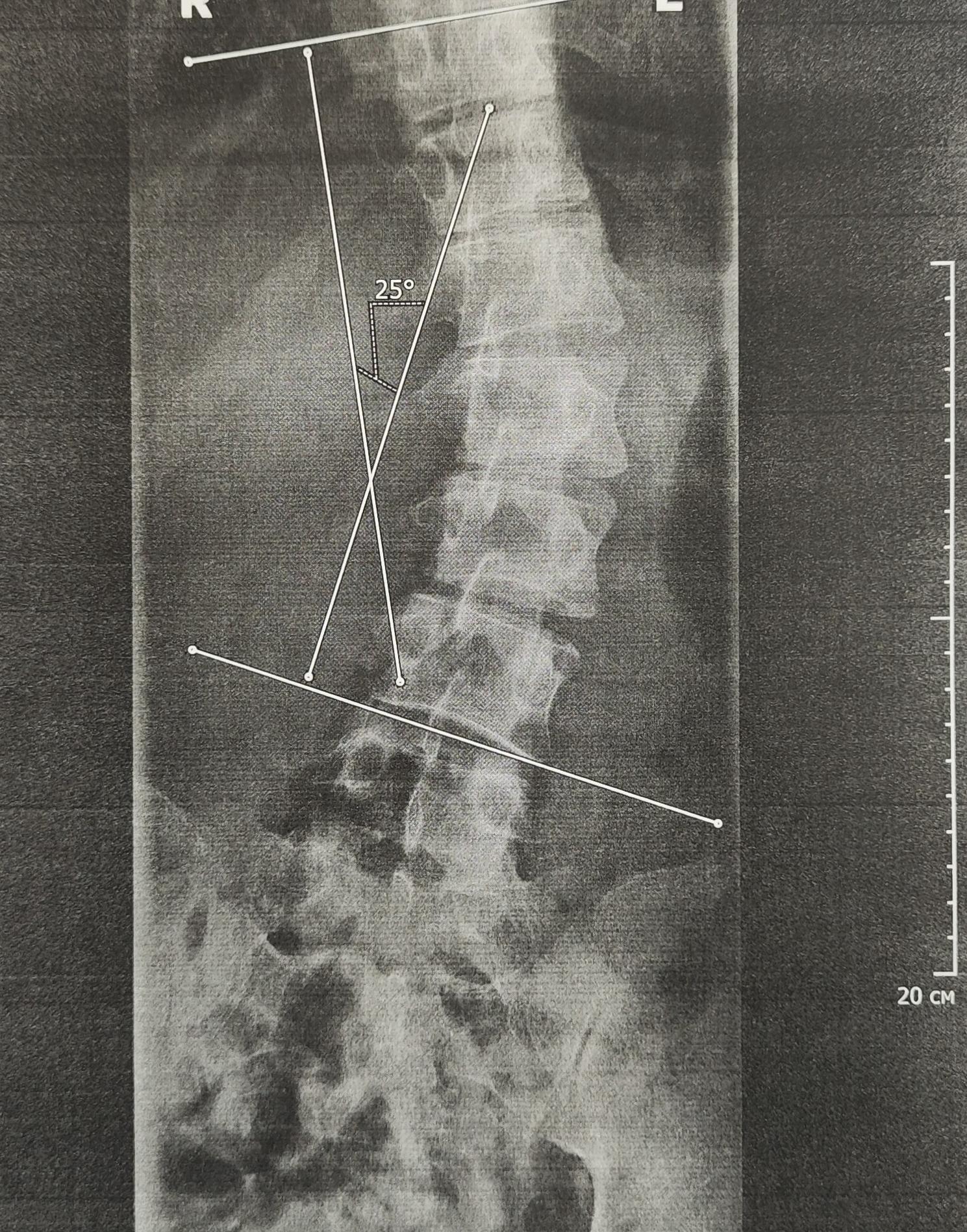 S-shaped scoliosis 2 degrees - My, Scoliosis, Spine, Curvature of the spine, Army, Military enlistment office, The medicine, X-ray, Radiology, Longpost