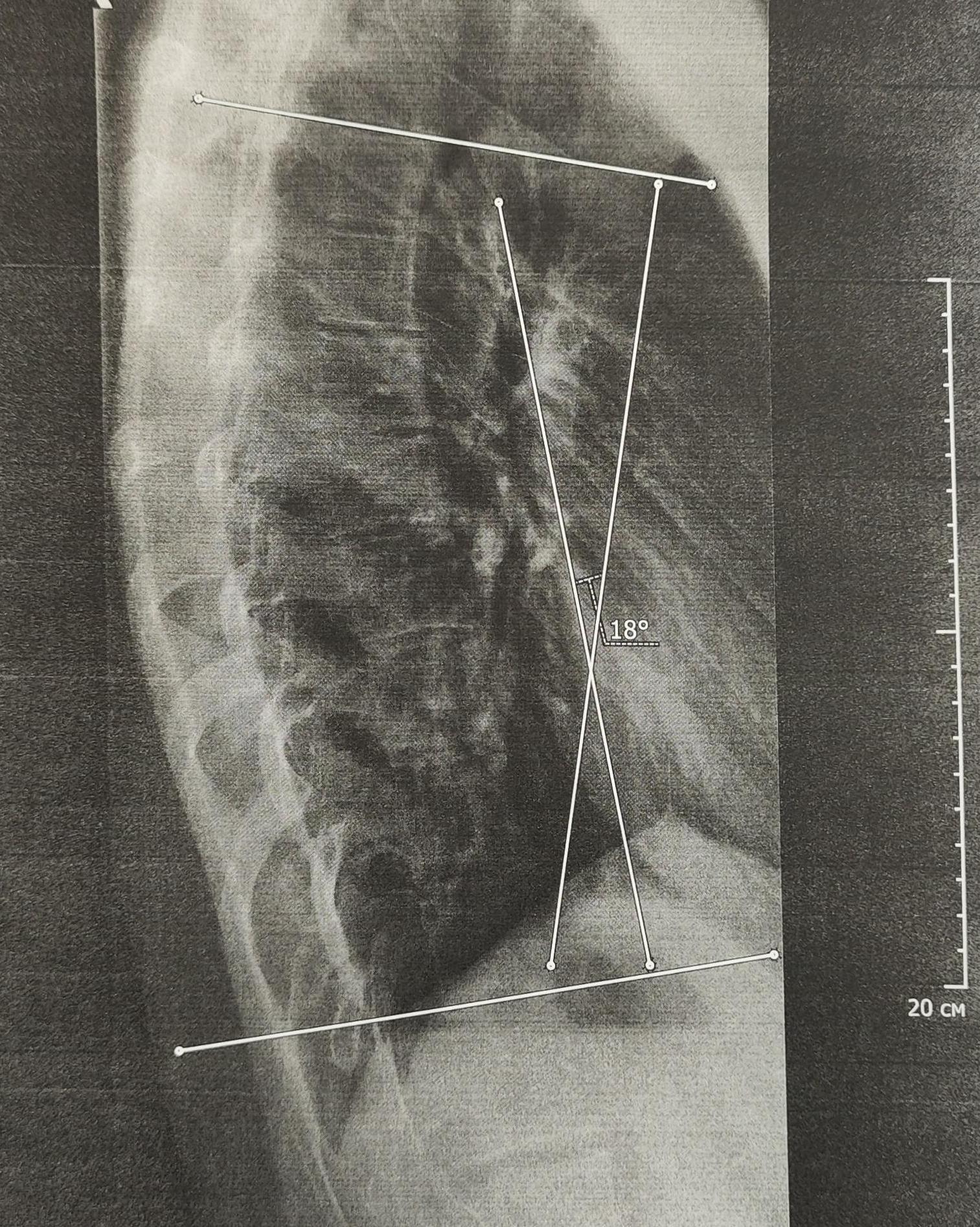 S-shaped scoliosis 2 degrees - My, Scoliosis, Spine, Curvature of the spine, Army, Military enlistment office, The medicine, X-ray, Radiology, Longpost