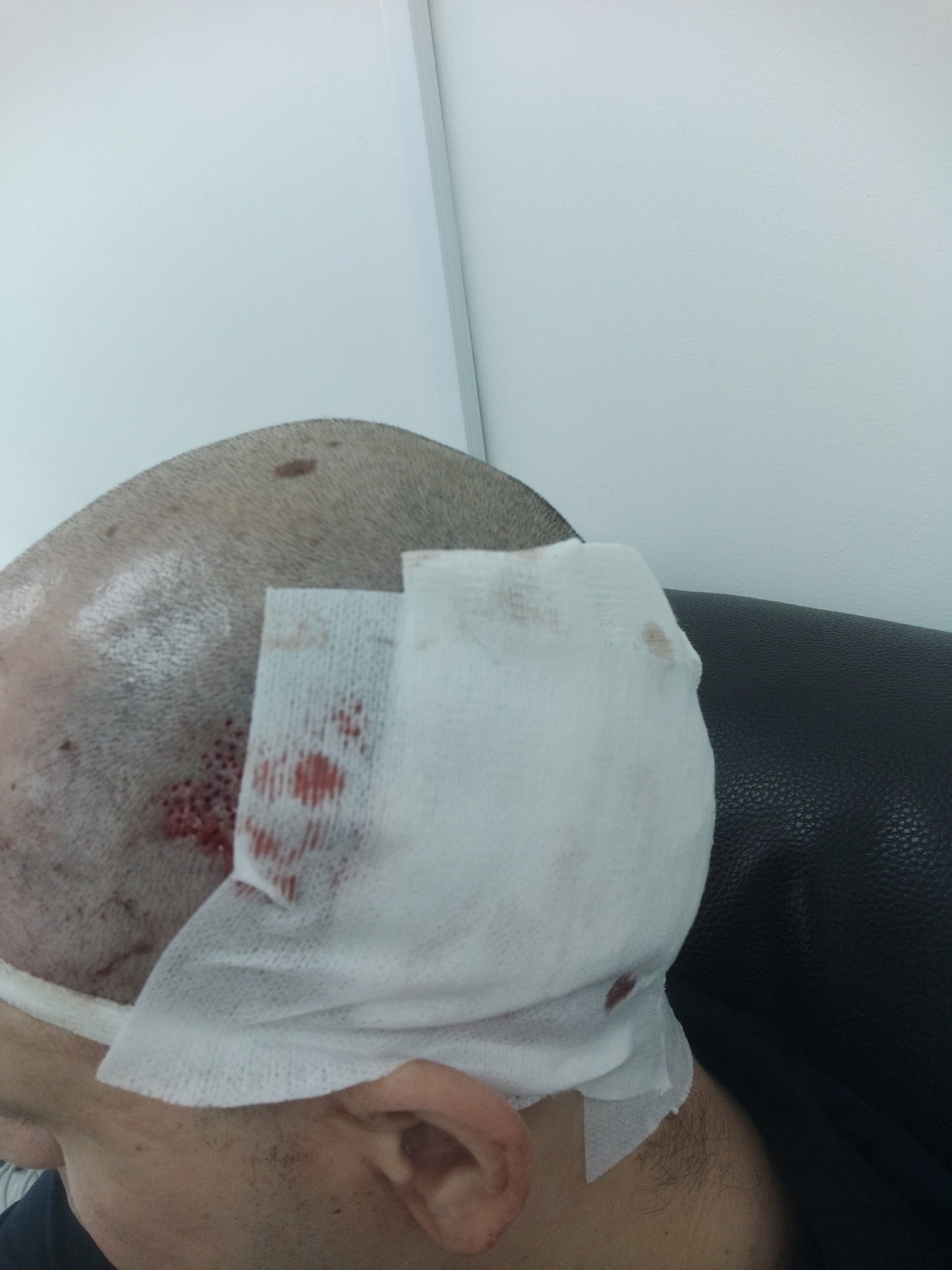 Had a hair transplant in Vladivostok - My, Hair Transplant, Hair, Baldness, Longpost, Alopecia, Operation