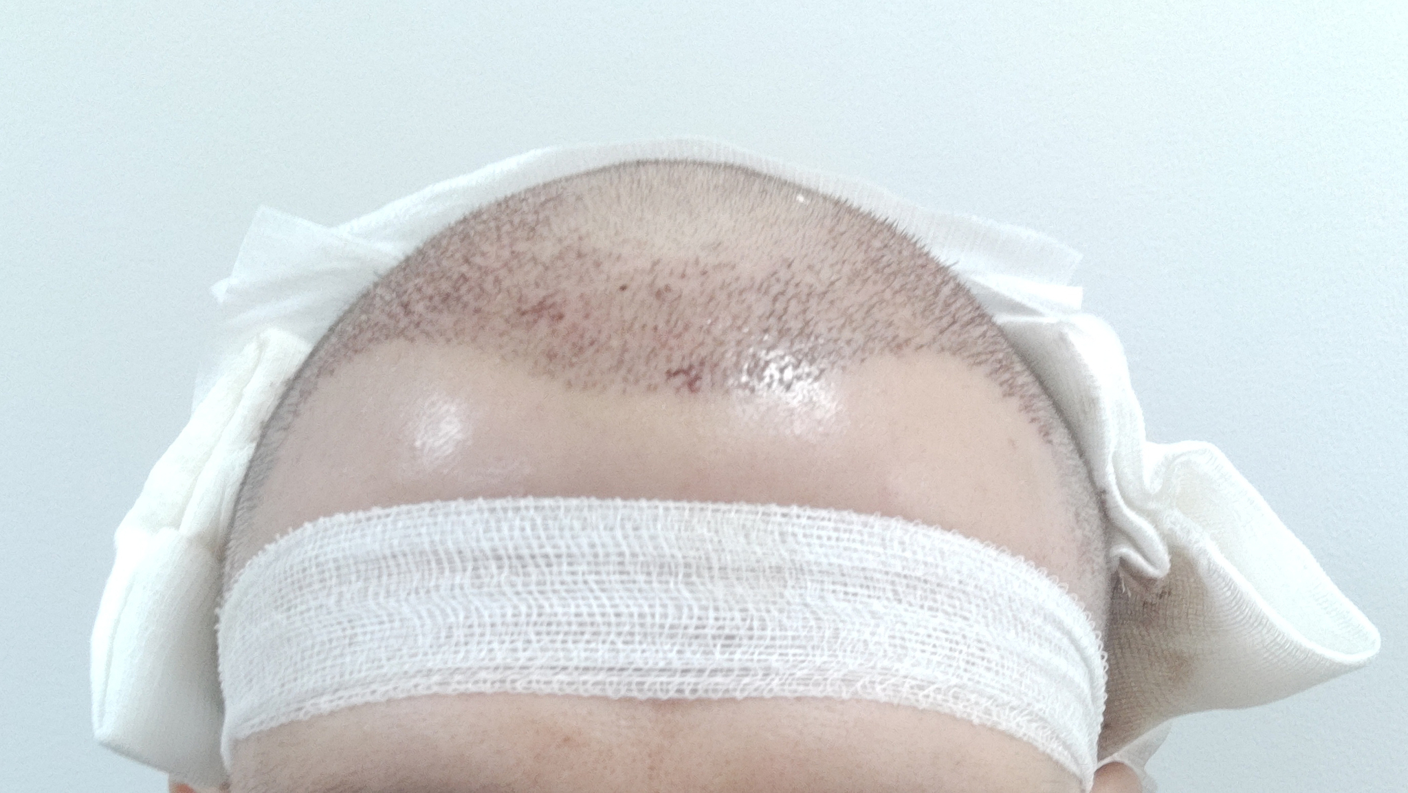 Had a hair transplant in Vladivostok - My, Hair Transplant, Hair, Baldness, Longpost, Alopecia, Operation