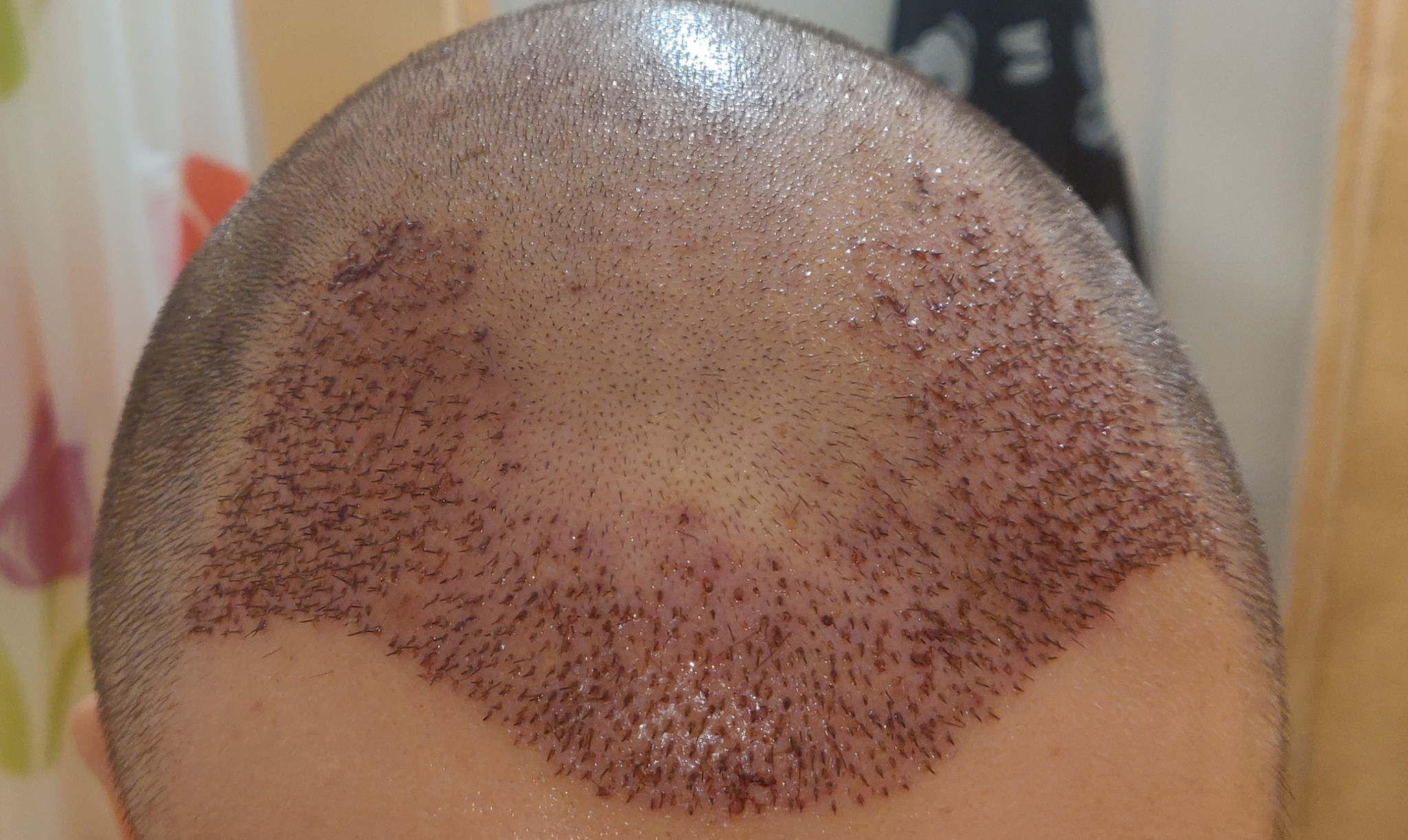 Had a hair transplant in Vladivostok - My, Hair Transplant, Hair, Baldness, Longpost, Alopecia, Operation