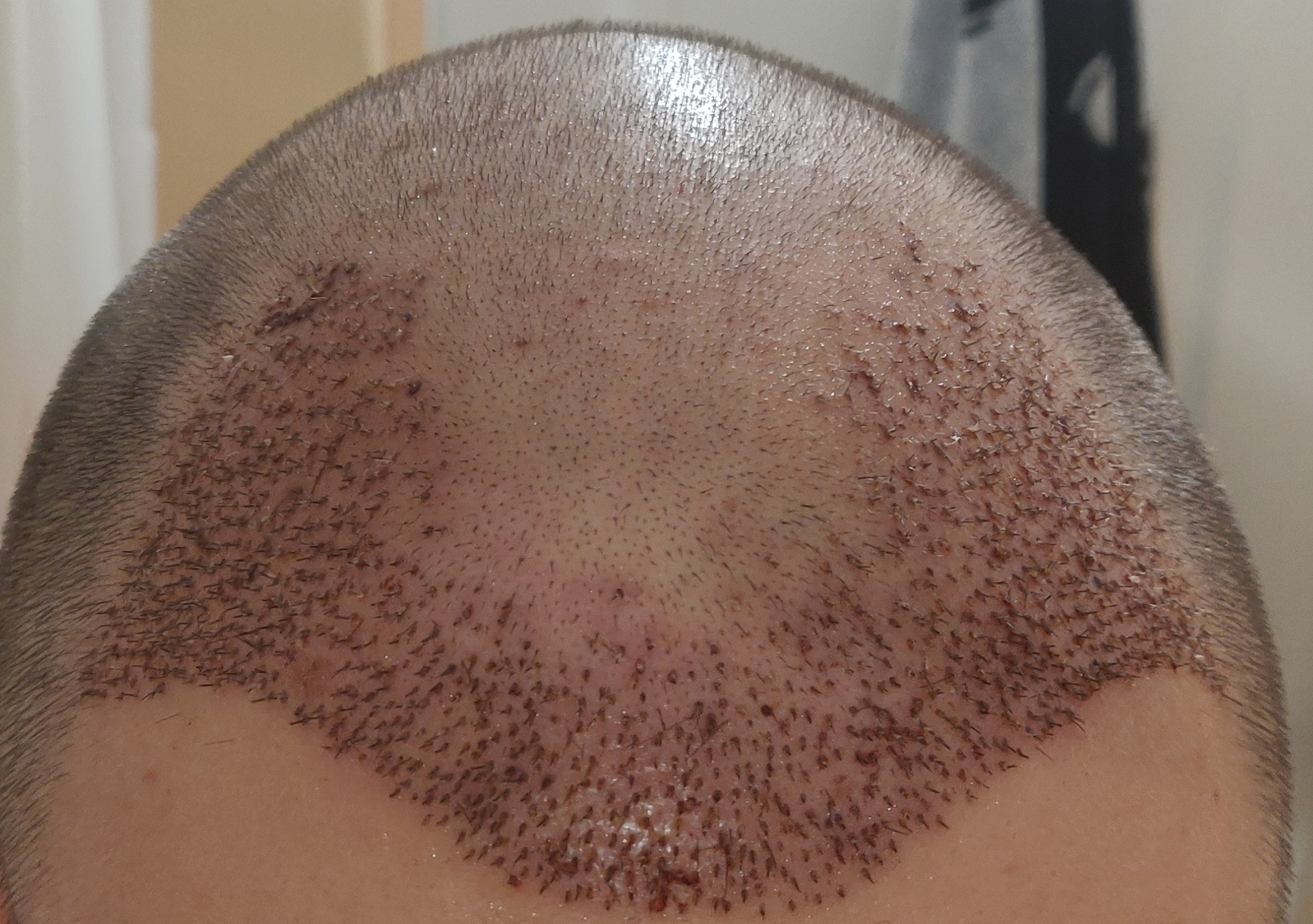 Had a hair transplant in Vladivostok - My, Hair Transplant, Hair, Baldness, Longpost, Alopecia, Operation