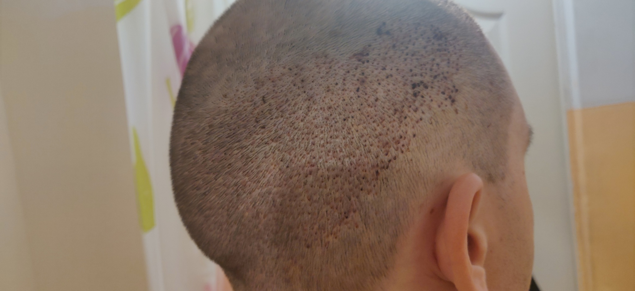 Had a hair transplant in Vladivostok - My, Hair Transplant, Hair, Baldness, Longpost, Alopecia, Operation