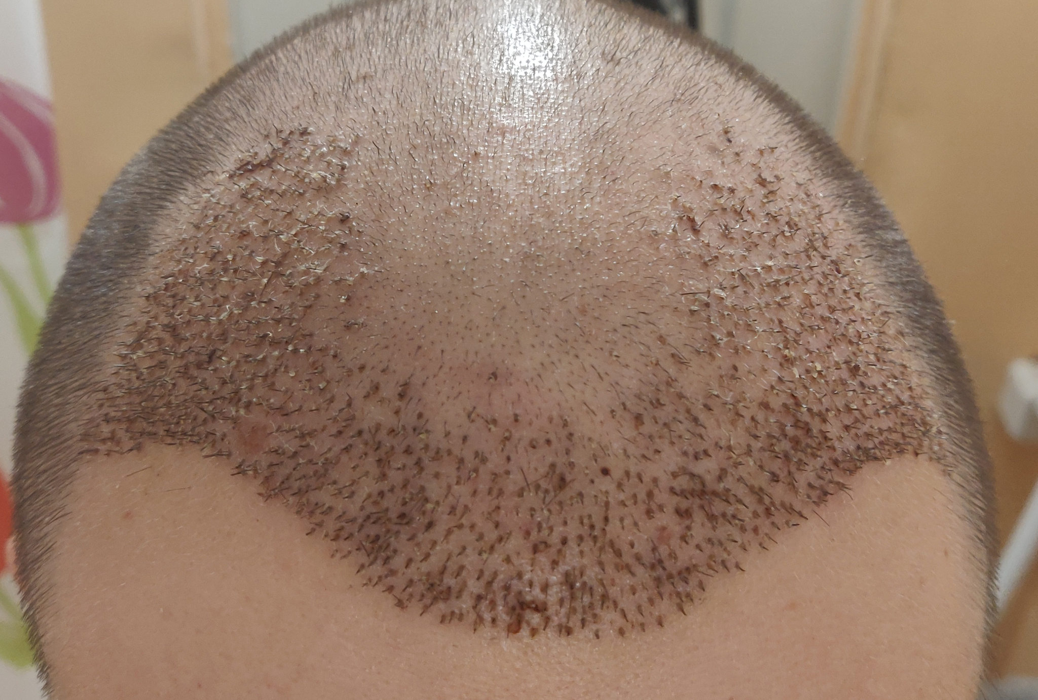 Had a hair transplant in Vladivostok - My, Hair Transplant, Hair, Baldness, Longpost, Alopecia, Operation