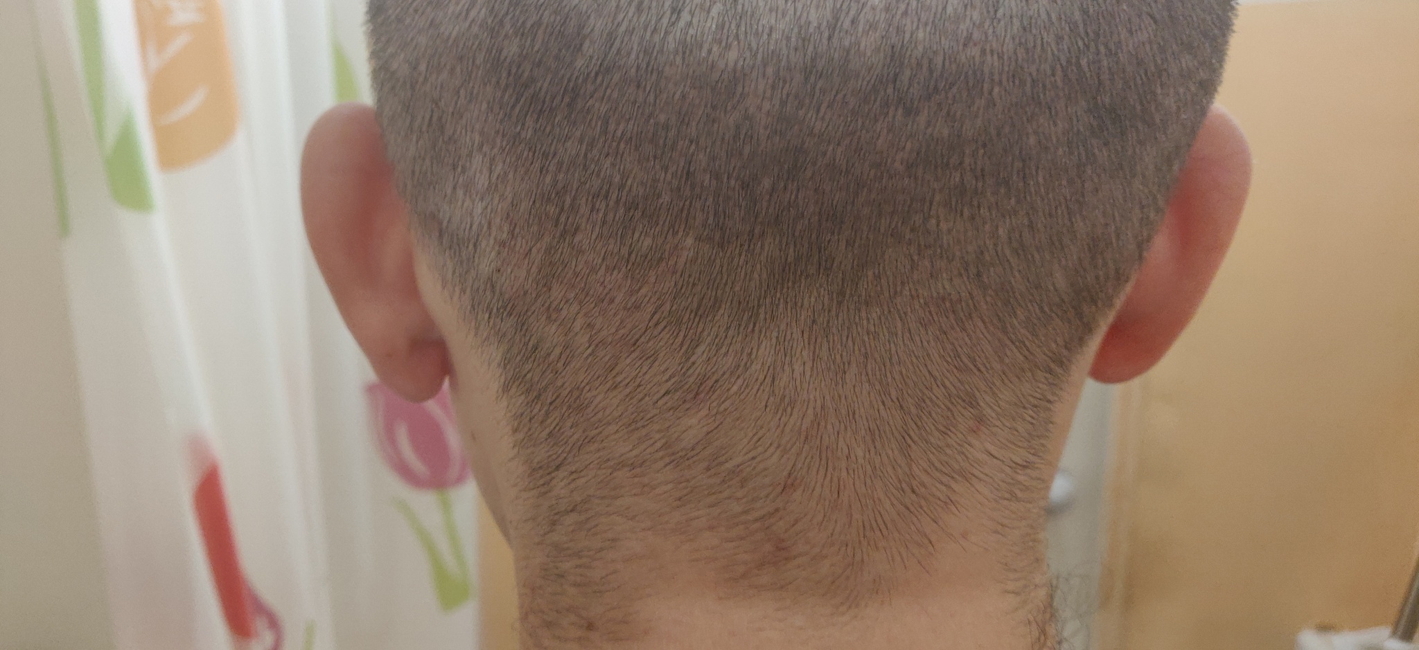 Had a hair transplant in Vladivostok - My, Hair Transplant, Hair, Baldness, Longpost, Alopecia, Operation