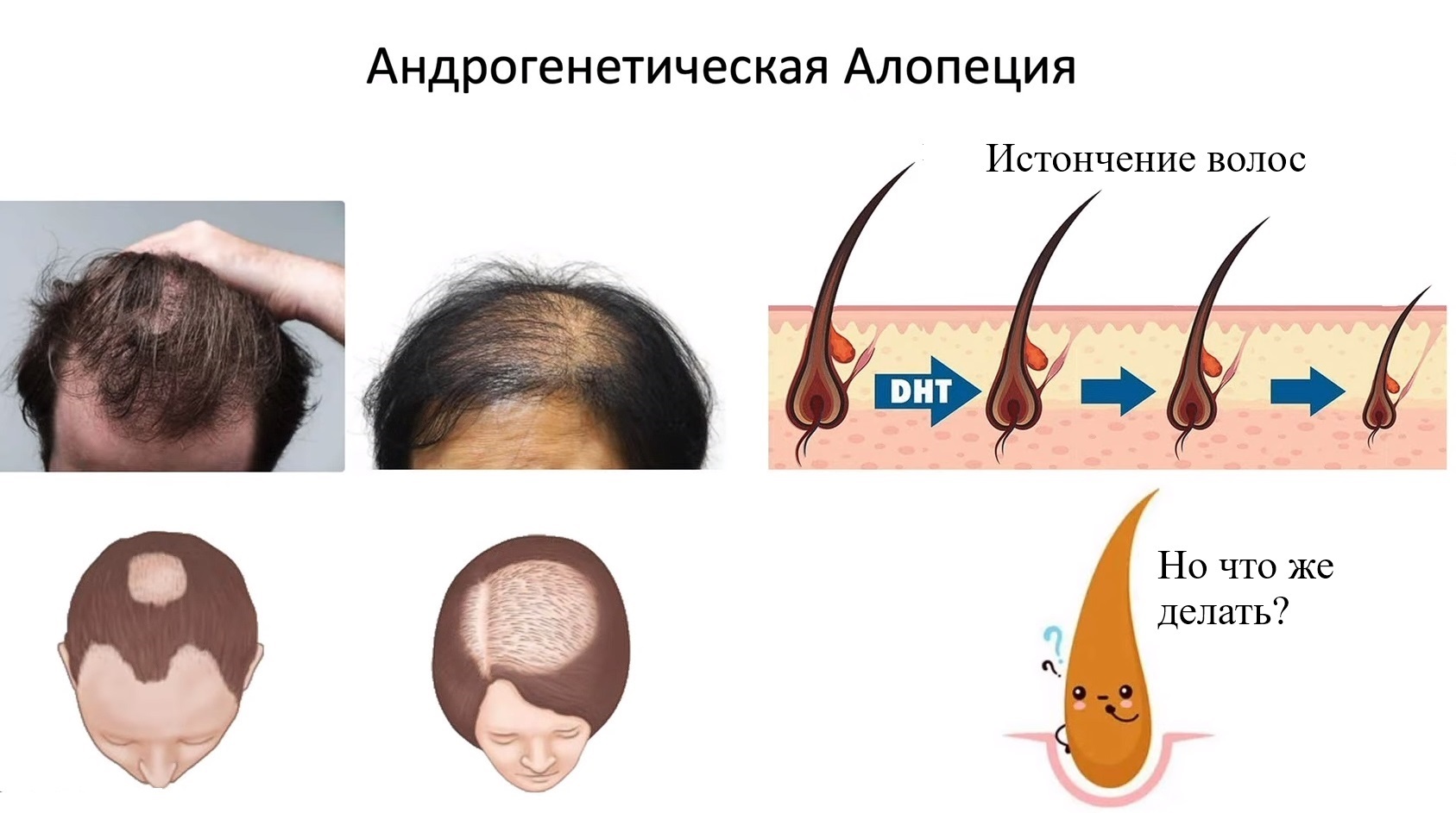 Finasteride for baldness, is it really necessary? - My, Minoxidil, Baldness, Alopecia, Health, Hormones, Medications, Treatment, Disease, Longpost, Bald, Therapy, Research, The medicine, Finasteride, Dutasteride