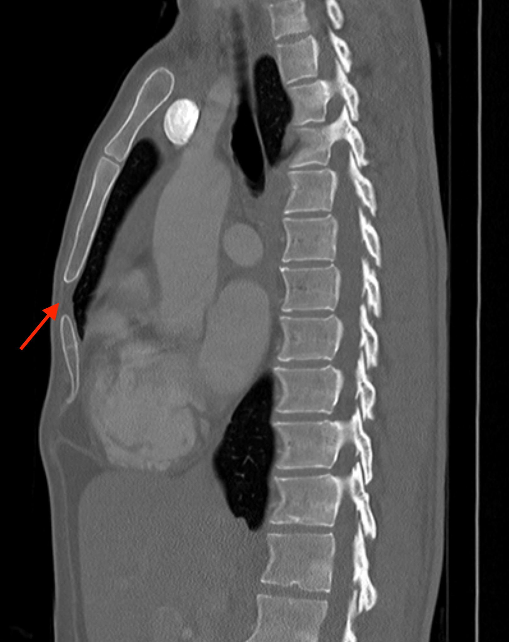 Case Studies: A Chink in the Armor - My, The medicine, Personal experience, This is the norm, Bones, CT, Radiology, Radiologist, Longpost