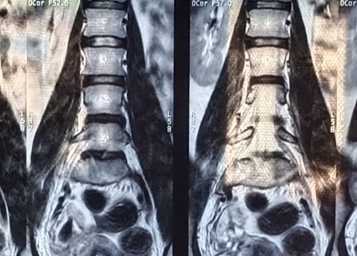 What are the dark spots on the MRI of the spine? Lumbar region. Anyone who understands, please tell me - My, MRI, Spine, Health