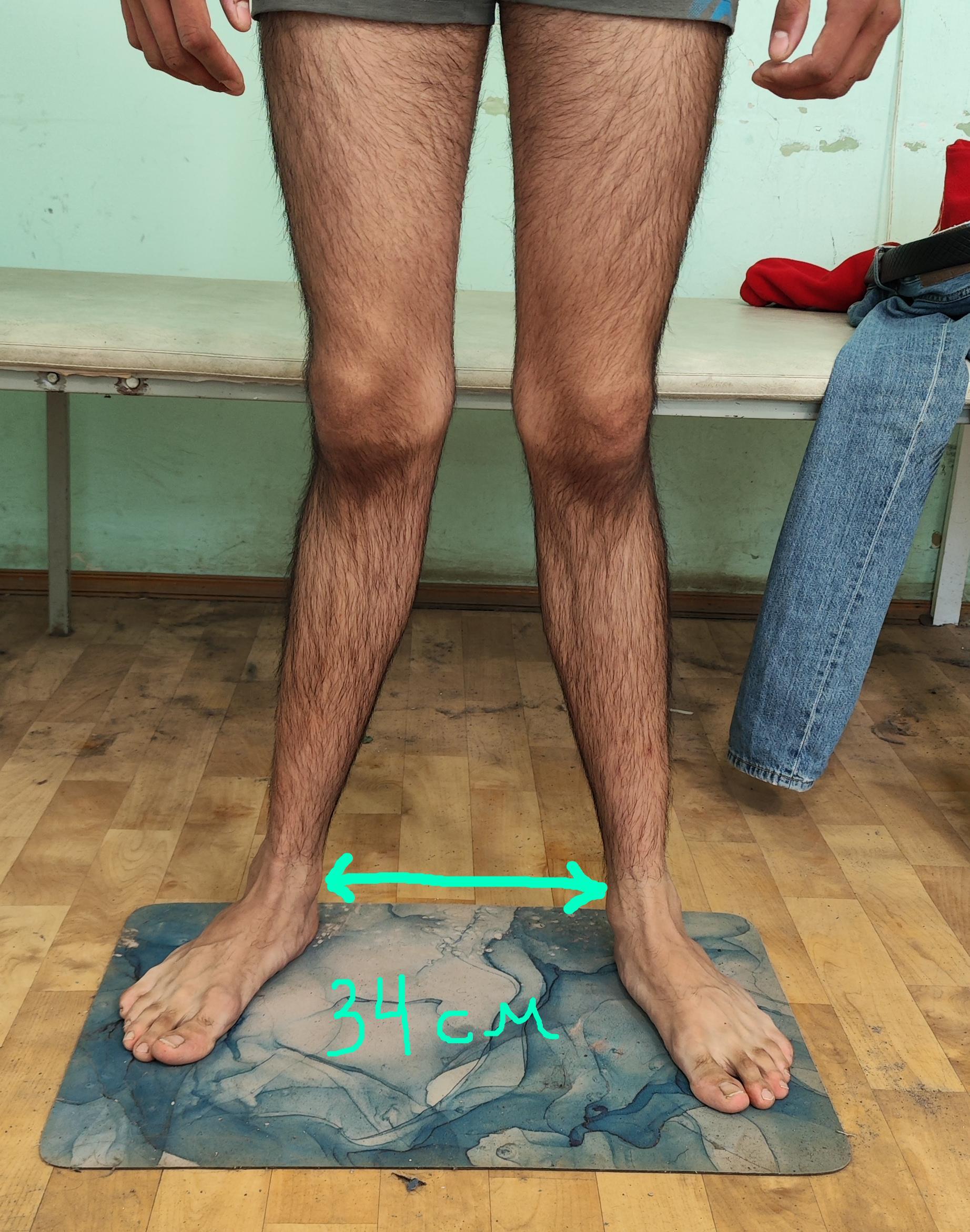 X-shaped deformity of the lower extremities - My, The medicine, Army, Health, Military enlistment office, Legs, Deformation, Flat feet, Orthopedics, X-ray, Longpost