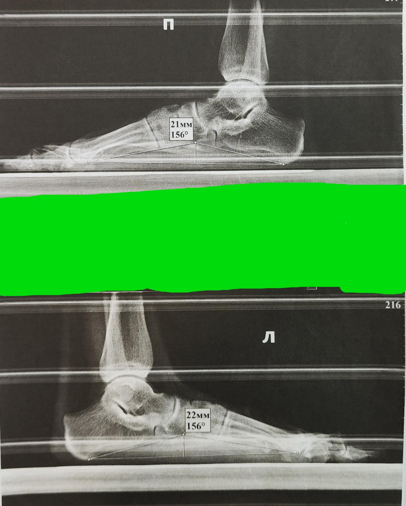 X-shaped deformity of the lower extremities - My, The medicine, Army, Health, Military enlistment office, Legs, Deformation, Flat feet, Orthopedics, X-ray, Longpost