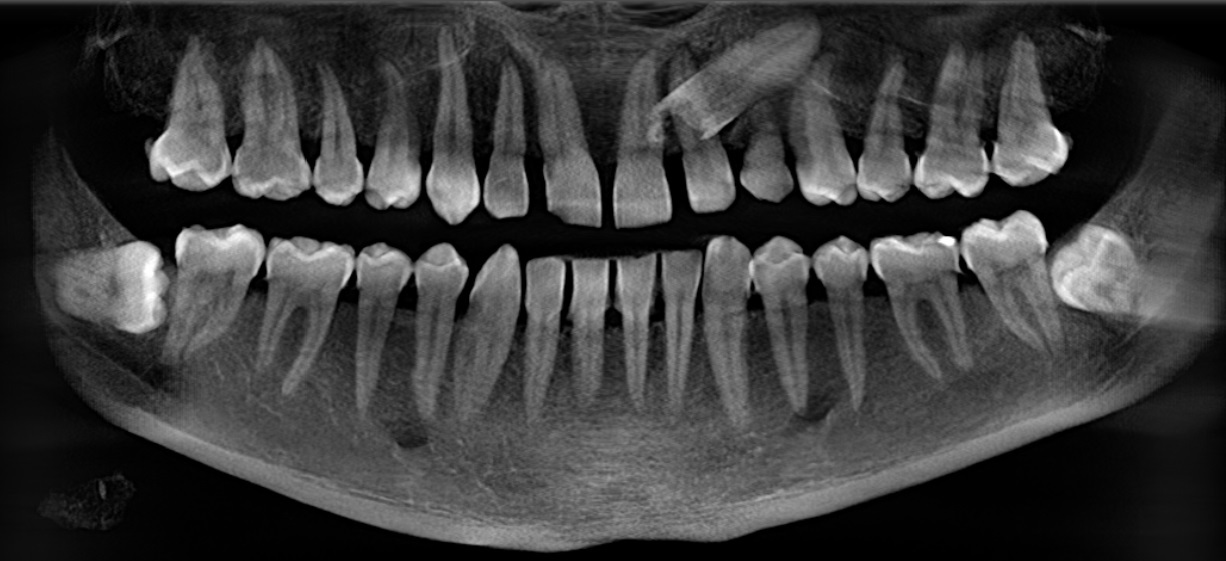 Removing an impacted canine: how is it done? - My, Teeth, The medicine, Operation, Polyclinic, Dental implantation, Удаление, Extraction of teeth, Mat, Longpost, Dentist, Doctors