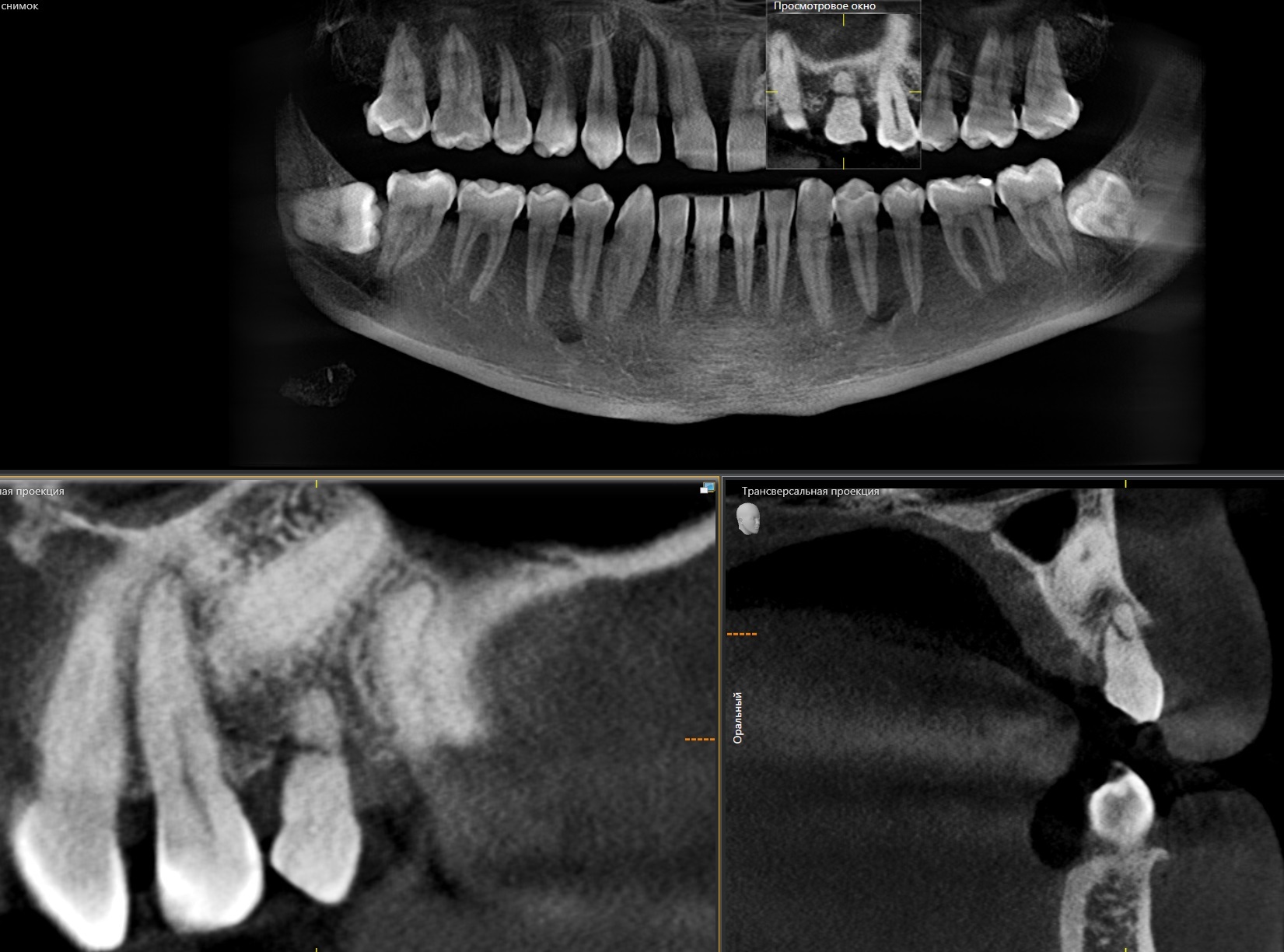 Removing an impacted canine: how is it done? - My, Teeth, The medicine, Operation, Polyclinic, Dental implantation, Удаление, Extraction of teeth, Mat, Longpost, Dentist, Doctors