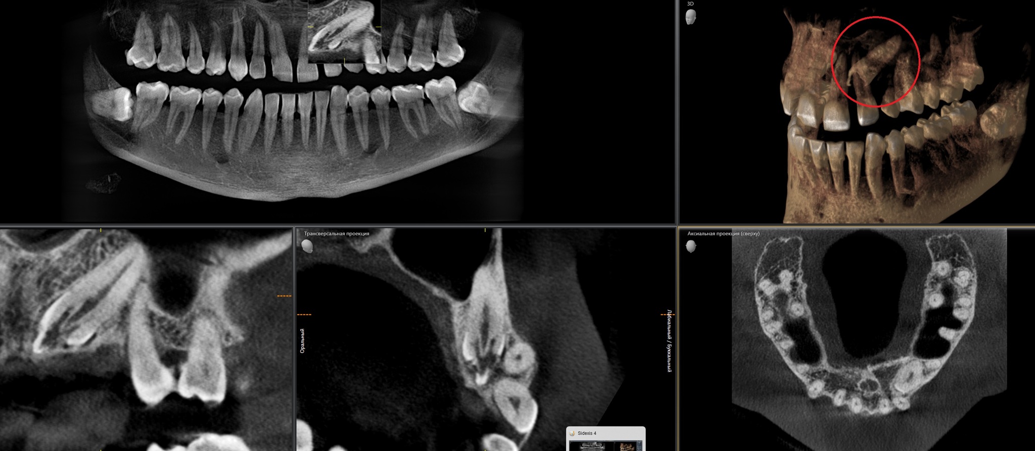 Removing an impacted canine: how is it done? - My, Teeth, The medicine, Operation, Polyclinic, Dental implantation, Удаление, Extraction of teeth, Mat, Longpost, Dentist, Doctors