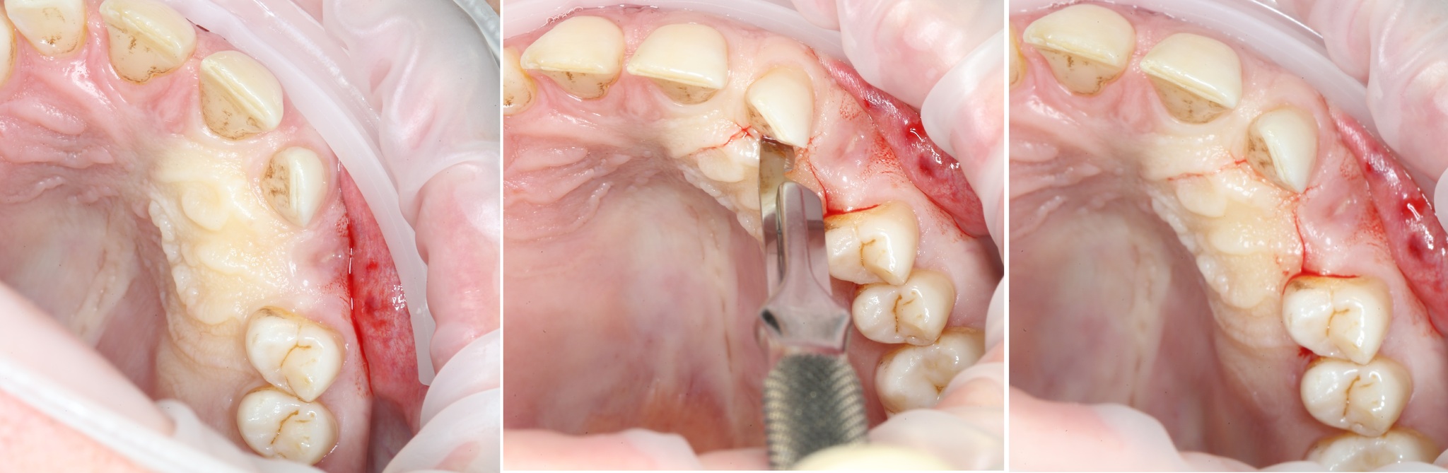 Removing an impacted canine: how is it done? - My, Teeth, The medicine, Operation, Polyclinic, Dental implantation, Удаление, Extraction of teeth, Mat, Longpost, Dentist, Doctors